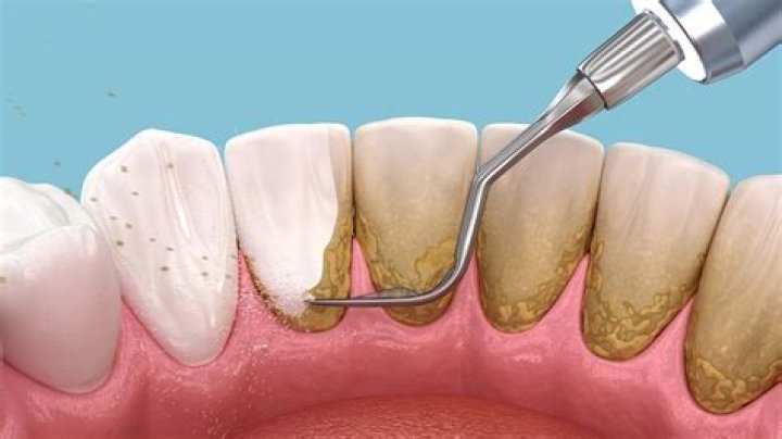 Can polishing teeth remove enamel?