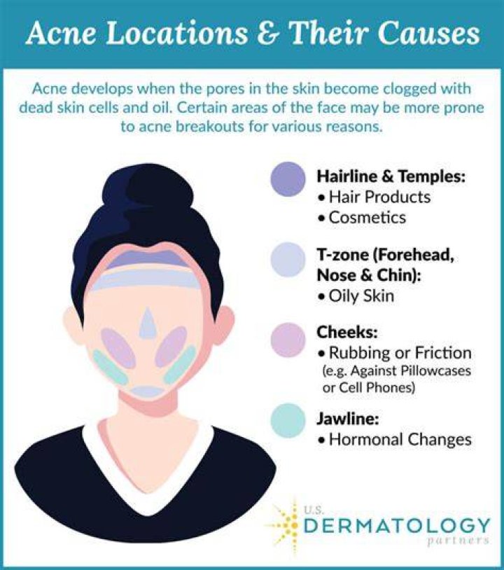Do humectants cause acne?