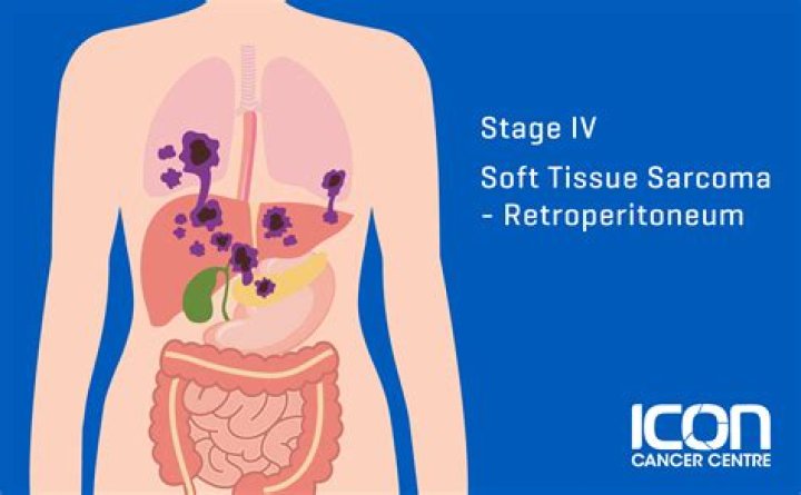 Do soft tissue sarcomas spread?