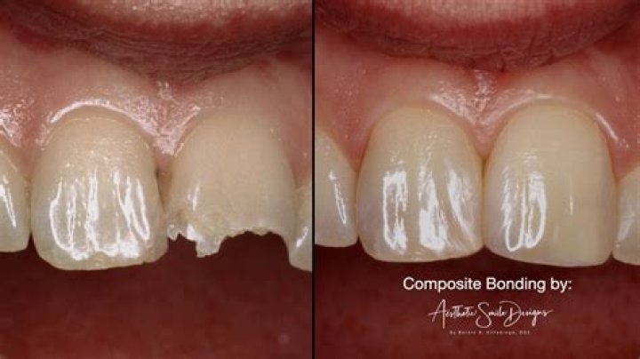 Does composite bonding whiten teeth?