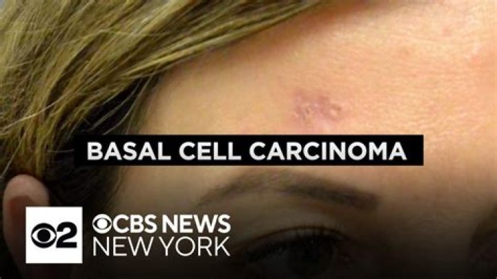 Has anyone died from basal cell carcinoma?