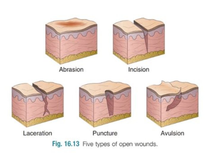 How do you treat avulsions?