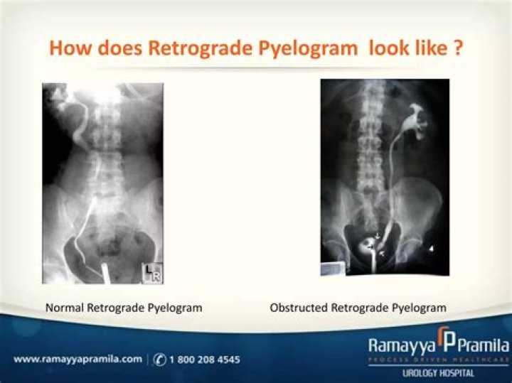 How is a retrograde pyelogram performed?
