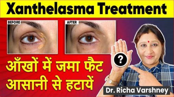 How to cure xanthelasma?