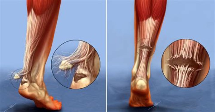 Were is the achilles tendon?