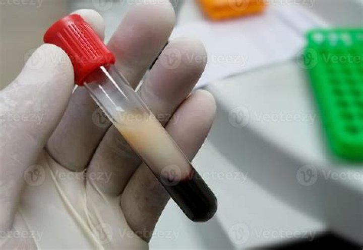 What causes lipemic blood sample?