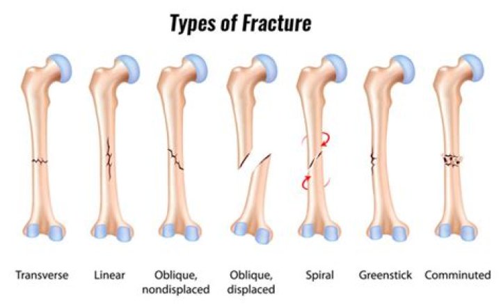 What is a subacute fracture?