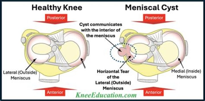 What is meniscal cyst?