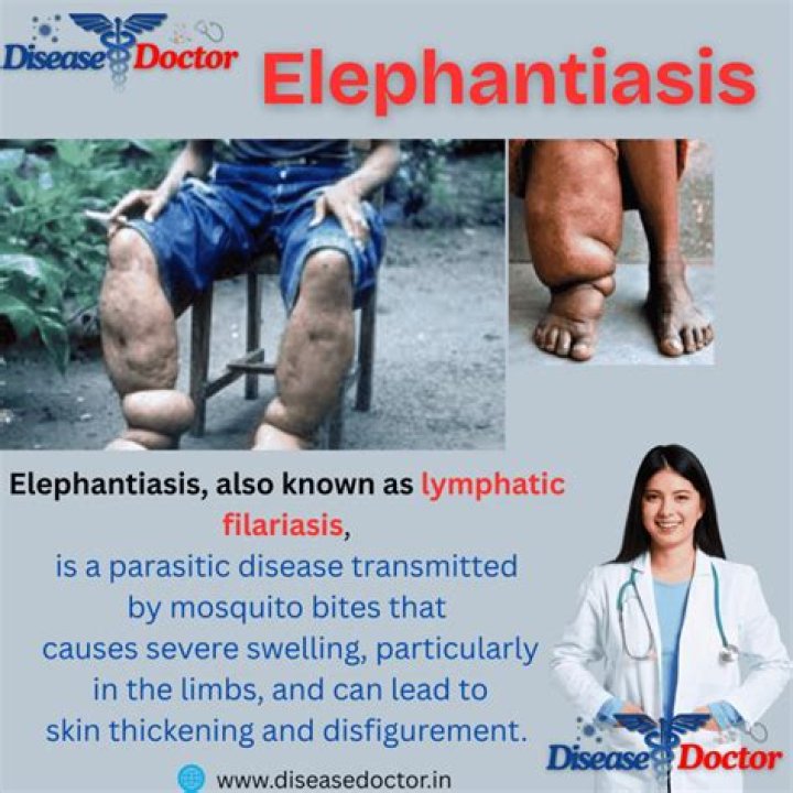 What is the main cause of elephantiasis?