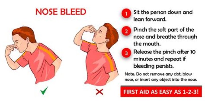 What to do when your nose bleeds?