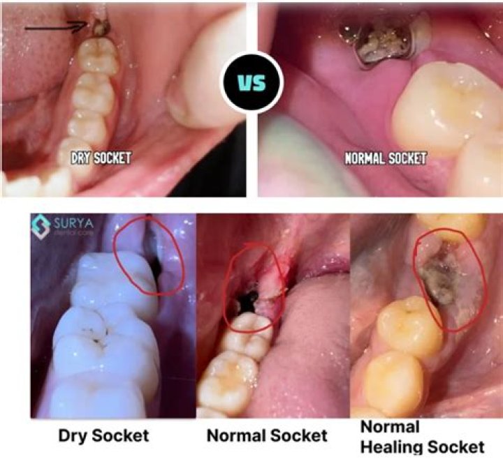 Whats a dry socket wisdom teeth?