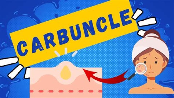 Why do carbuncle come back?