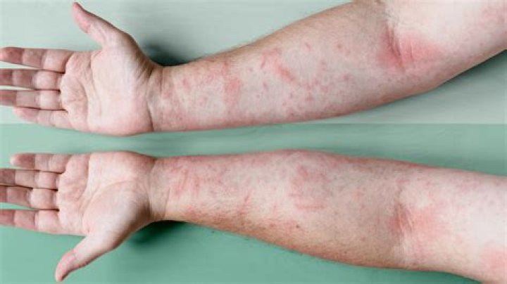 Why is atopic dermatitis worse at night?