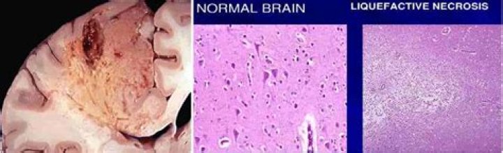 Why no coagulative necrosis in brain?