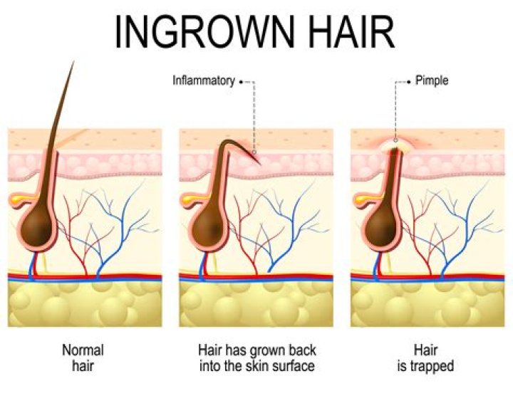 Will an ingrown hair sort itself out?