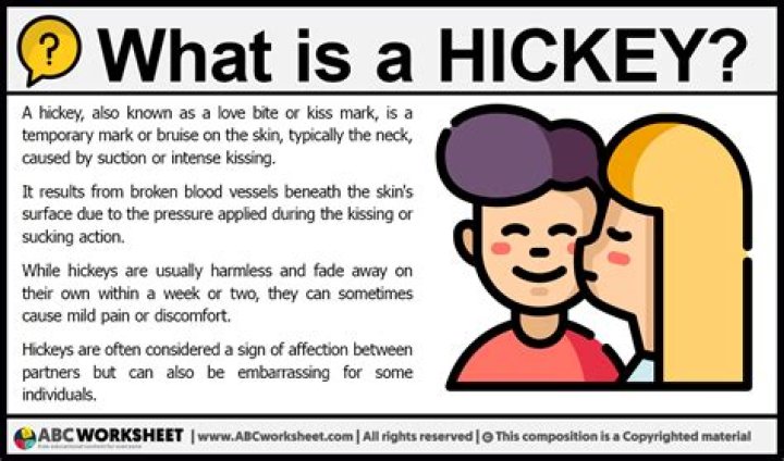 Will ice help get rid of a hickey?