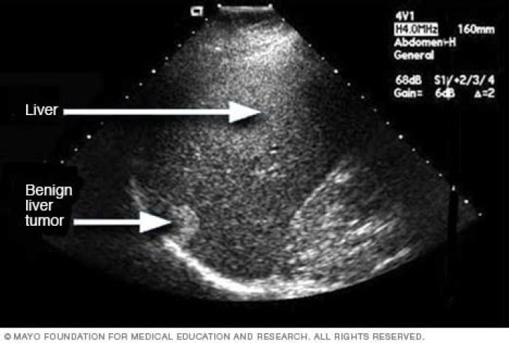 Would ultrasound show liver cancer?